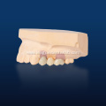 Implant Crown and Bridge
